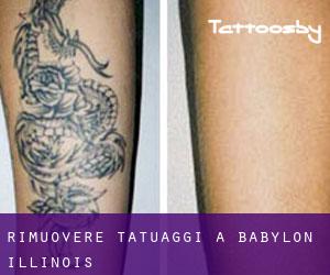 Rimuovere Tatuaggi a Babylon (Illinois)