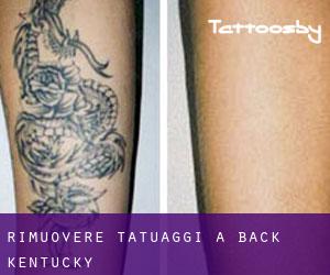 Rimuovere Tatuaggi a Back (Kentucky)