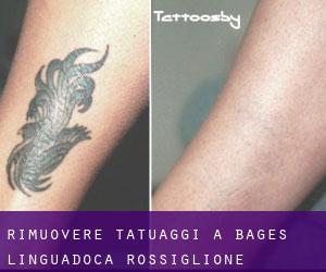 Rimuovere Tatuaggi a Bages (Linguadoca-Rossiglione)