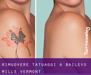 Rimuovere Tatuaggi a Baileys Mills (Vermont)