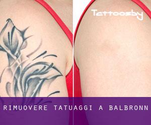 Rimuovere Tatuaggi a Balbronn
