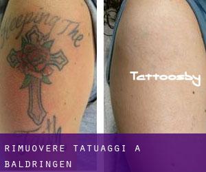 Rimuovere Tatuaggi a Baldringen