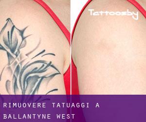 Rimuovere Tatuaggi a Ballantyne West