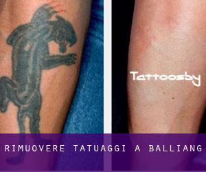 Rimuovere Tatuaggi a Balliang