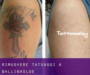 Rimuovere Tatuaggi a Ballinasloe