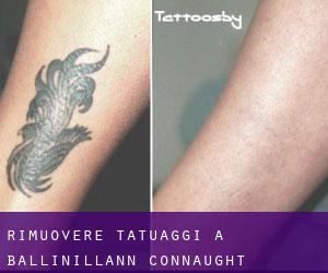 Rimuovere Tatuaggi a Ballinillann (Connaught)