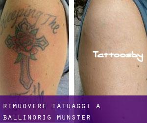 Rimuovere Tatuaggi a Ballinorig (Munster)