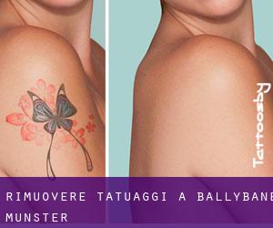 Rimuovere Tatuaggi a Ballybane (Munster)