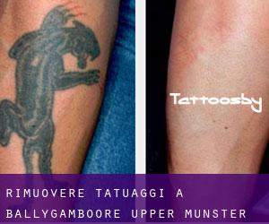 Rimuovere Tatuaggi a Ballygamboore Upper (Munster)