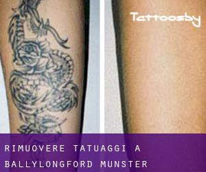 Rimuovere Tatuaggi a Ballylongford (Munster)