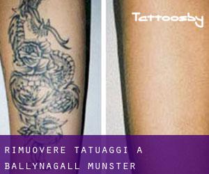 Rimuovere Tatuaggi a Ballynagall (Munster)