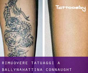 Rimuovere Tatuaggi a Ballynahattina (Connaught)