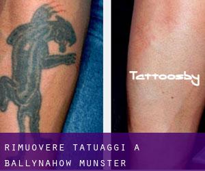 Rimuovere Tatuaggi a Ballynahow (Munster)