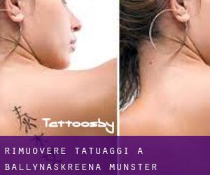 Rimuovere Tatuaggi a Ballynaskreena (Munster)