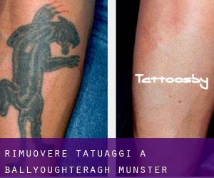 Rimuovere Tatuaggi a Ballyoughteragh (Munster)