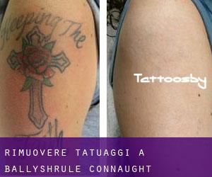 Rimuovere Tatuaggi a Ballyshrule (Connaught)