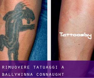 Rimuovere Tatuaggi a Ballywinna (Connaught)