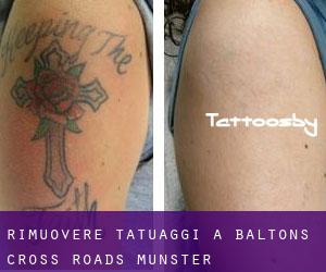 Rimuovere Tatuaggi a Balton's Cross Roads (Munster)