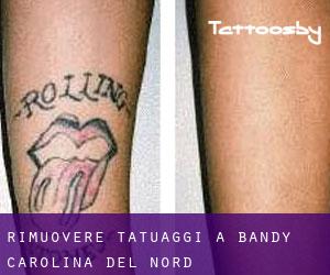 Rimuovere Tatuaggi a Bandy (Carolina del Nord)