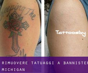 Rimuovere Tatuaggi a Bannister (Michigan)