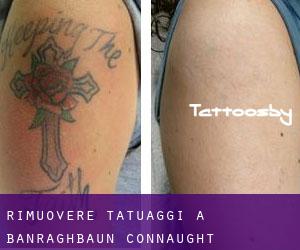 Rimuovere Tatuaggi a Banraghbaun (Connaught)