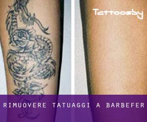 Rimuovere Tatuaggi a Barbefer
