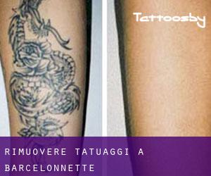 Rimuovere Tatuaggi a Barcelonnette