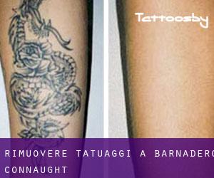 Rimuovere Tatuaggi a Barnaderg (Connaught)