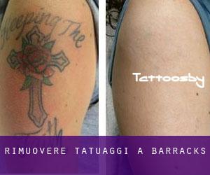 Rimuovere Tatuaggi a Barracks