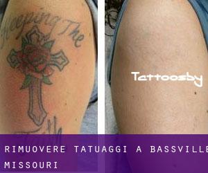 Rimuovere Tatuaggi a Bassville (Missouri)