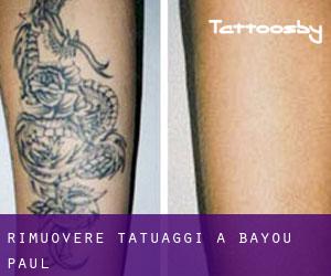 Rimuovere Tatuaggi a Bayou Paul