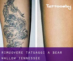 Rimuovere Tatuaggi a Bear Wallow (Tennessee)