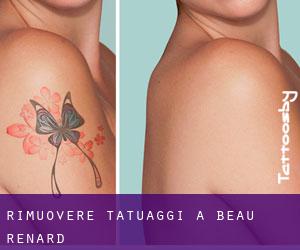 Rimuovere Tatuaggi a Beau-Renard