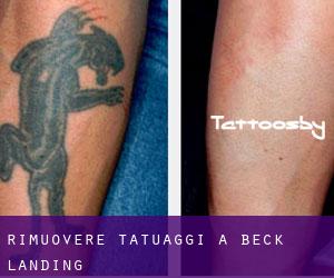 Rimuovere Tatuaggi a Beck Landing