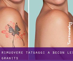 Rimuovere Tatuaggi a Bécon-les-Granits