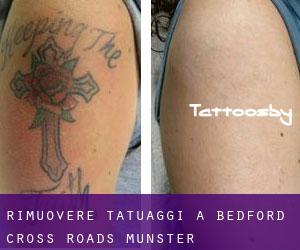 Rimuovere Tatuaggi a Bedford Cross Roads (Munster)