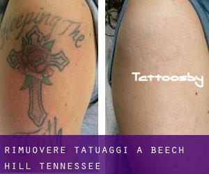 Rimuovere Tatuaggi a Beech Hill (Tennessee)