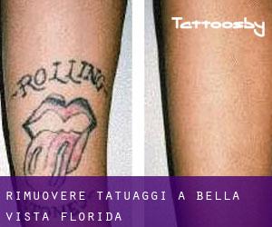 Rimuovere Tatuaggi a Bella Vista (Florida)