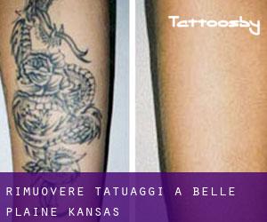 Rimuovere Tatuaggi a Belle Plaine (Kansas)