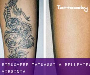 Rimuovere Tatuaggi a Belleview (Virginia)