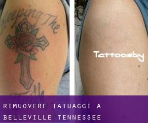 Rimuovere Tatuaggi a Belleville (Tennessee)