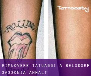 Rimuovere Tatuaggi a Belsdorf (Sassonia-Anhalt)