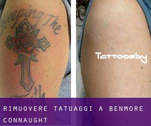 Rimuovere Tatuaggi a Benmore (Connaught)