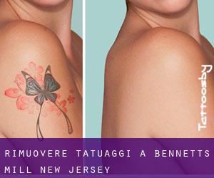 Rimuovere Tatuaggi a Bennetts Mill (New Jersey)
