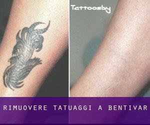 Rimuovere Tatuaggi a Bentivar