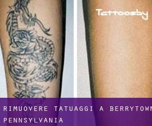 Rimuovere Tatuaggi a Berrytown (Pennsylvania)