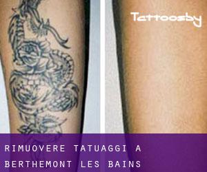 Rimuovere Tatuaggi a Berthemont-les-Bains