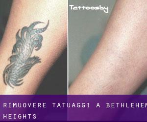 Rimuovere Tatuaggi a Bethlehem Heights