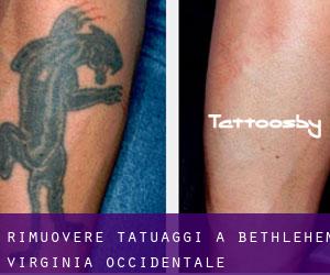 Rimuovere Tatuaggi a Bethlehem (Virginia Occidentale)