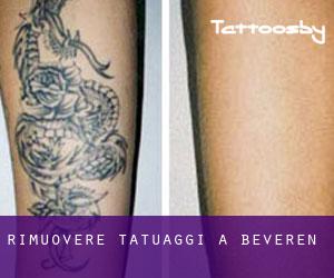 Rimuovere Tatuaggi a Beveren